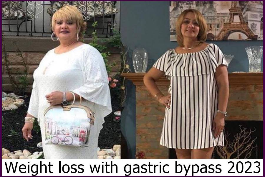 Weight loss with gastric bypass 2023