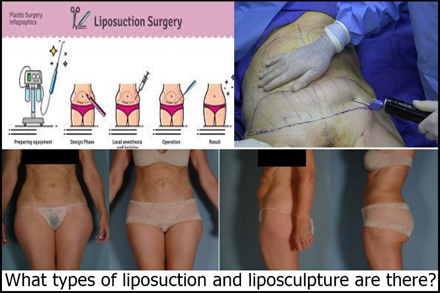 What types of liposuction and liposculpture are there?
