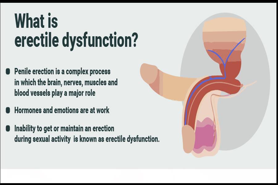 Erectile dysfunction: Nonoral treatments 2023